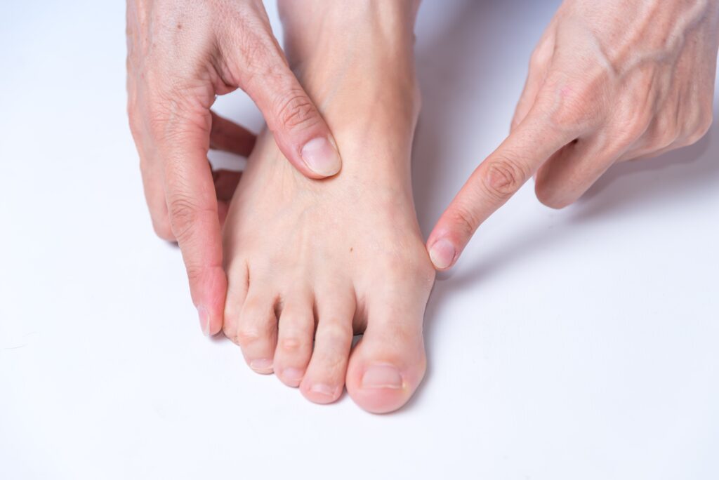 Close-up of a foot with a visible bunion, illustrating joint misalignment, arthritis, and related foot health concerns commonly treated with orthopedic or podiatric care