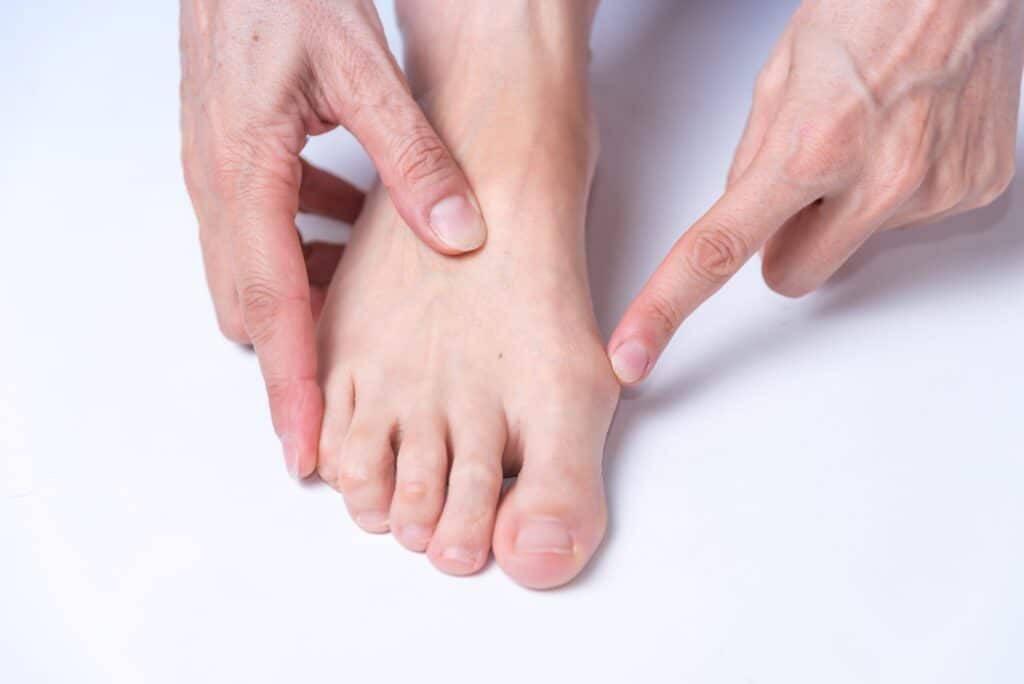 Close-up of a foot with a visible bunion, illustrating joint misalignment, arthritis, and related foot health concerns commonly treated with orthopedic or podiatric care