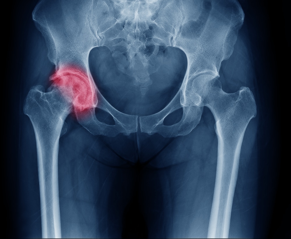 X-ray image of hip showing osteoarthritis in right hip joint with highlighted red pain area.