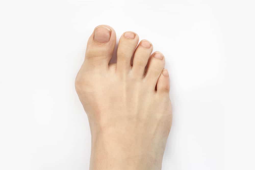 Close-up of foot showing hallux valgus deformity with bunion on big toe, concept of orthopedic foot condition and podiatry care.
